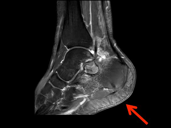 Sagittal T1w SPIR (post gado)