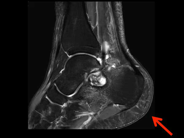 Sagittal T2w mDIXON