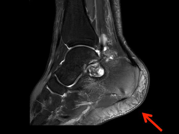 Sagittal T2w SPAIR