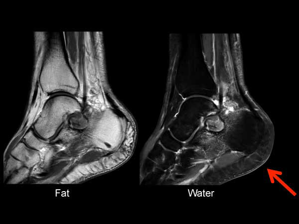 Sagittal T1w mDIXON (post gado)