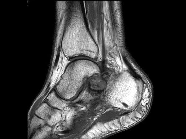 Sagittal T1w TSE (post gado)