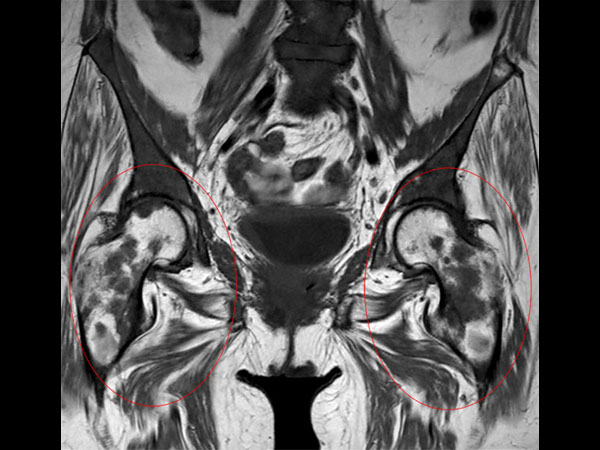 Coronal T1w TSE of the pelvis