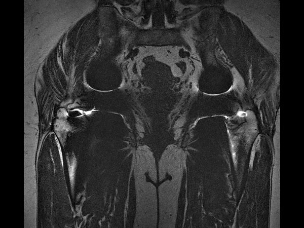 Coronal T1w MARS