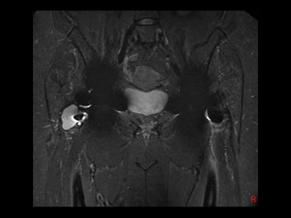 Coronal STIR MARS