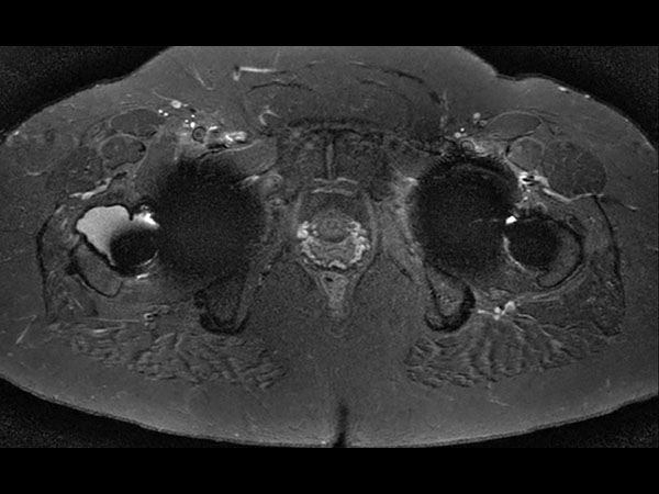 Axial STIR TSE