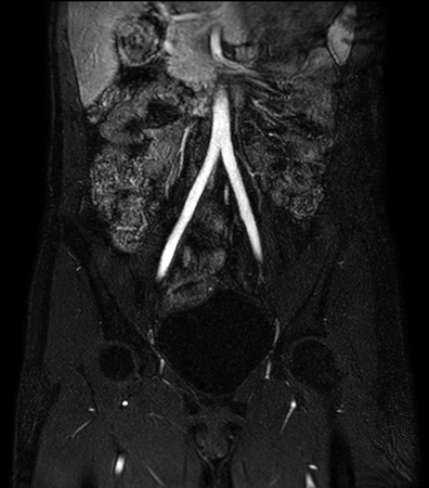 mDIXON XD MRA (abdomen)