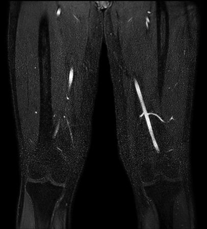 mDIXON XD MRA (upper legs)