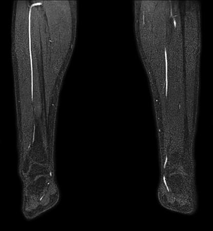 mDIXON XD MRA (lower legs)