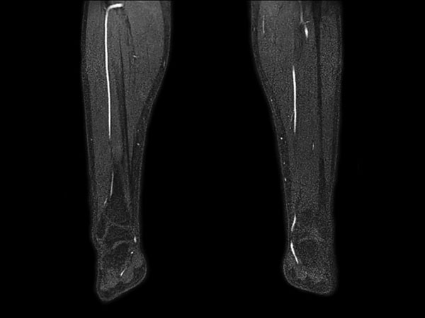 mDIXON XD MRA (lower legs)