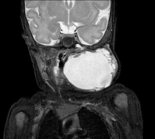 Coronal mDIXON XD - T2w TSE (Water only)
