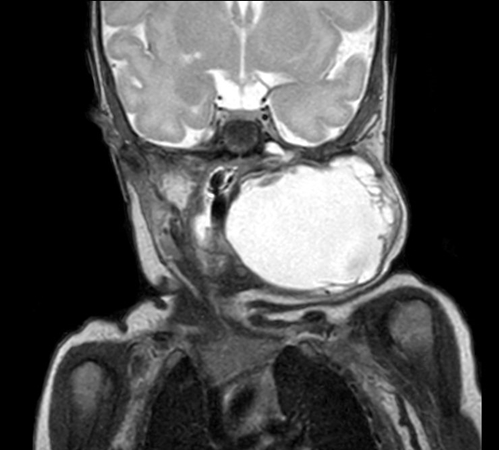 Coronal mDIXON XD - T2w TSE (In Phase)