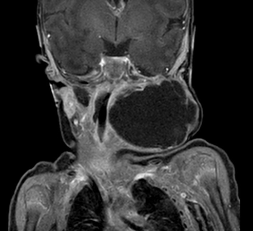 Coronal mDIXON XD - T1w TSE (Water only)