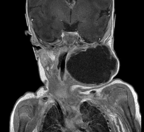 Coronal mDIXON XD - T1w TSE (In Phase)