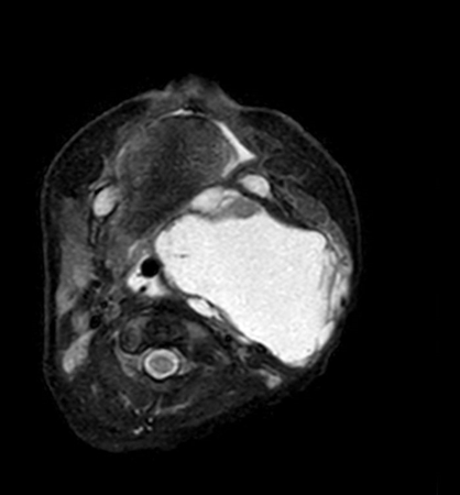 Axial mDIXON XD - T2w TSE (Water only)