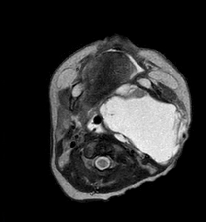 Axial mDIXON XD - T2w TSE (In Phase)