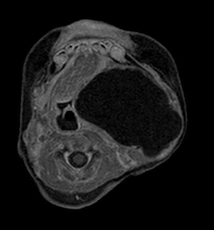 Axial mDIXON XD - T1w TSE (Water only)