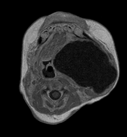 Axial mDIXON XD - T1w TSE (In Phase)