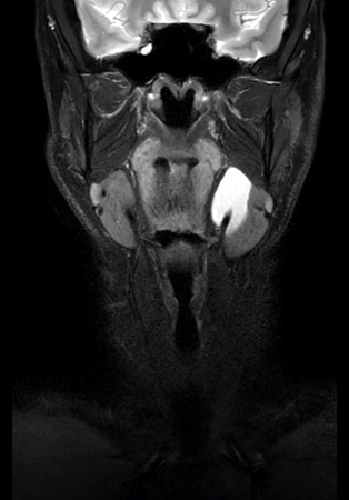 Coronal mDIXON XD - T2w TSE (Water only)