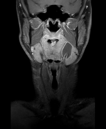 Coronal mDIXON XD - T1w TSE (Water only)