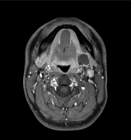 Axial mDIXON XD - T1w TSE (Water only)