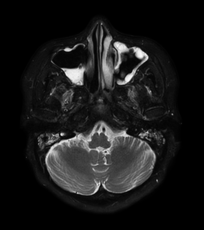 Axial mDIXON XD - T2w TSE (Water only)