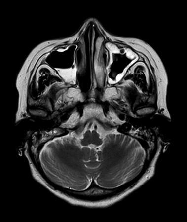 Axial mDIXON XD - T2w TSE (In Phase)
