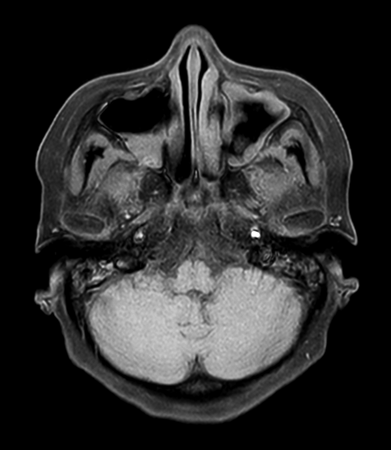 Axial mDIXON XD - T1w TSE (Water only)