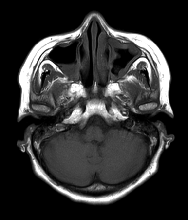 Axial mDIXON XD - T1w TSE (In Phase)