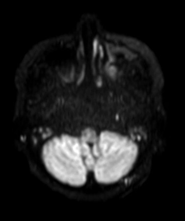 Axial DWI TSE (b1000)