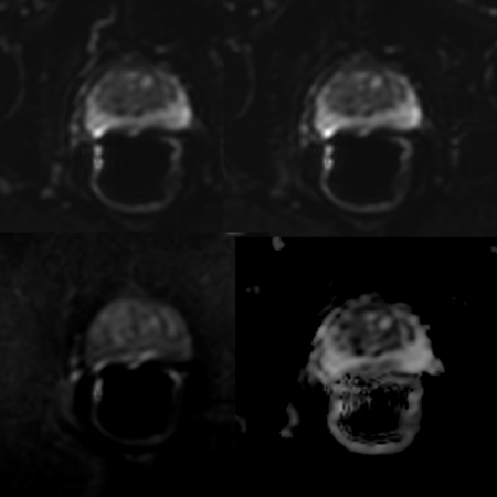 Axial DWI (b0, b50, b1500, ADC)