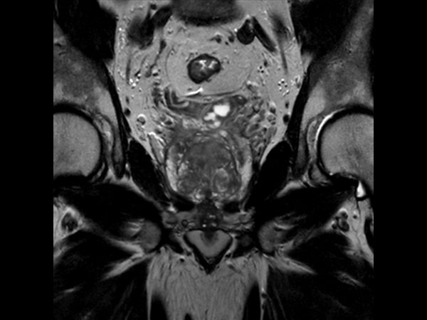 Coronal T2w TSE