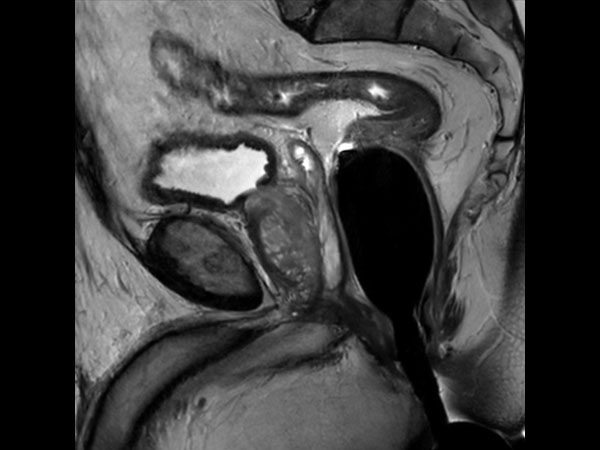 Sagittal T2w TSE