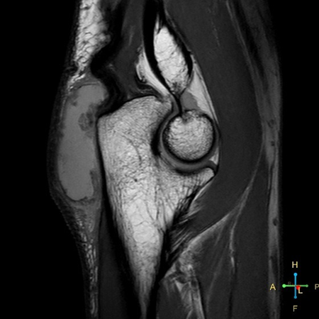 Sagittal PDw TSE