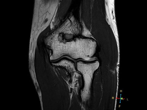 Coronal PDw TSE