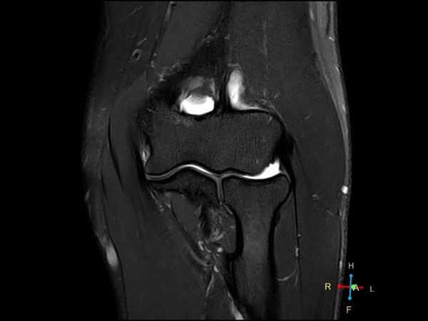 Coronal T2w SPAIR