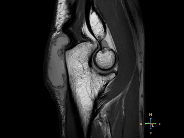 Sagittal PDw TSE