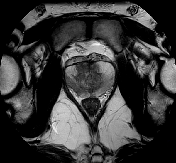 Axial MultiVane XD - T2w TSE