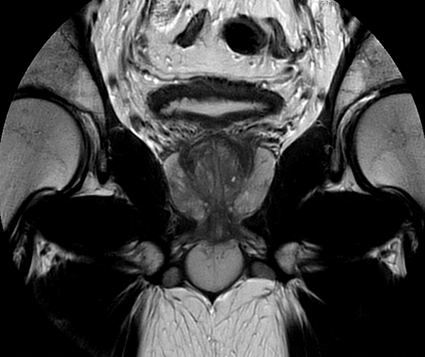 Coronal MultiVane XD - T2w TSE 