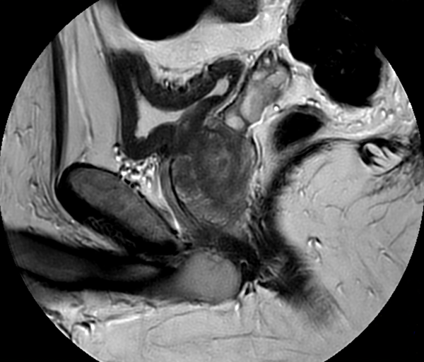 Sagittal MultiVane XD - T2w TSE 