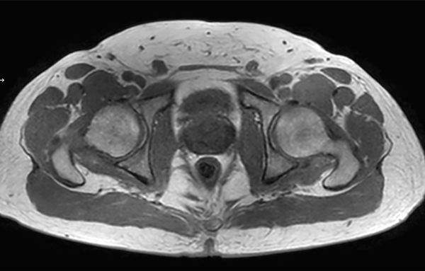mDIXON XD - T1w FFE (In Phase)