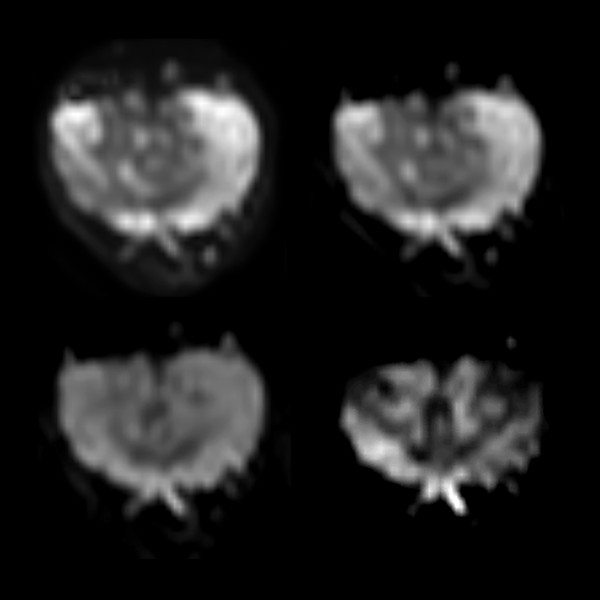 dS Zoom DWI (b50, b400, b800, b1400)