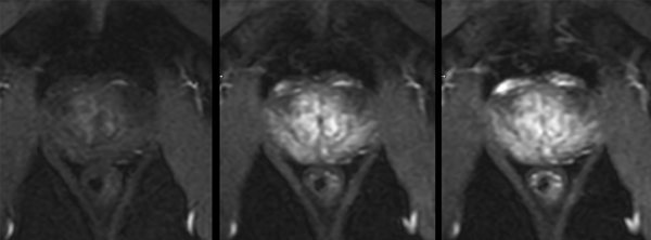 T1 Perfusion (29 sec, 44 sec, 58 sec)