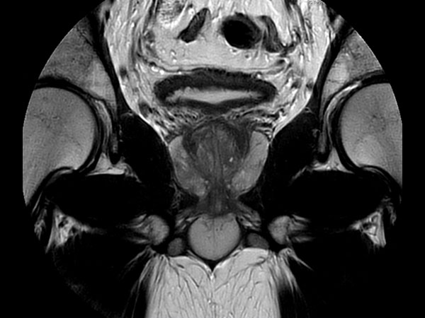 Coronal MultiVane XD - T2w TSE 