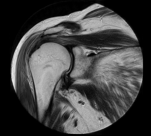 Coronal MultiVane XD - T2w TSE
