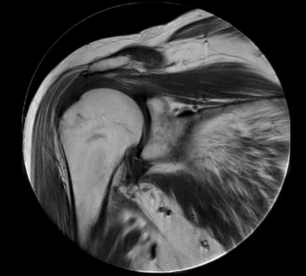 Coronal MultiVane XD - T1w TSE
