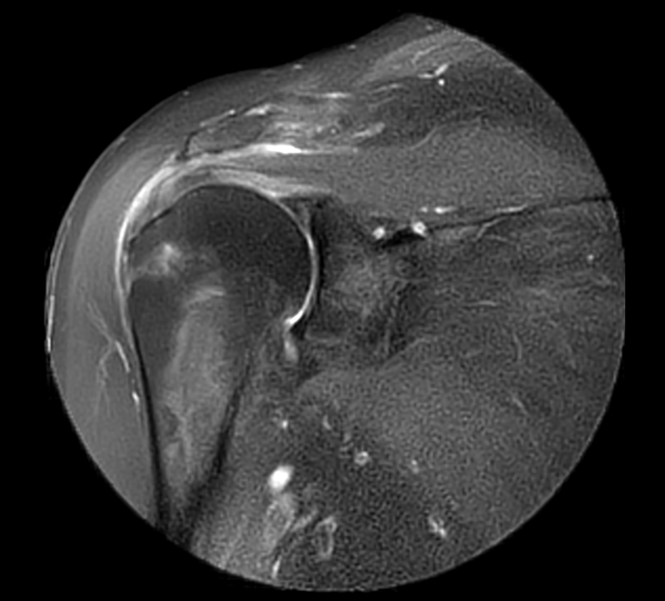 Coronal MultiVane XD - PDw SPAIR