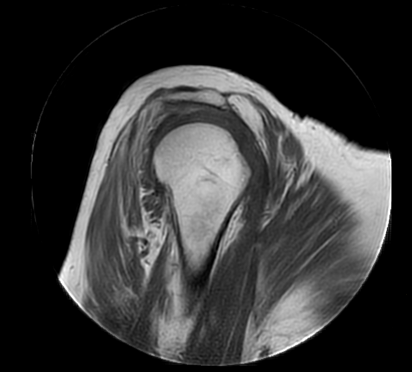 Sagittal MultiVane XD - T1w TSE