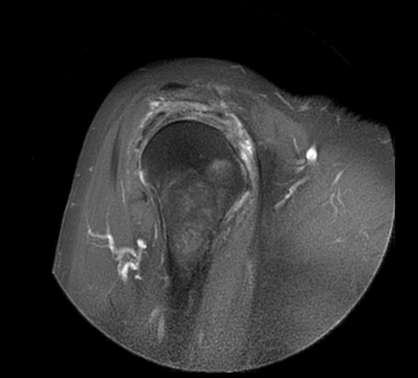 Sagittal MultiVane XD - PDw SPAIR