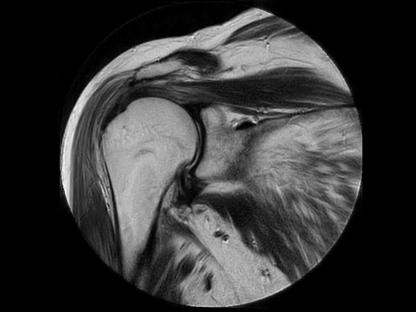 Coronal MultiVane XD - T2w TSE