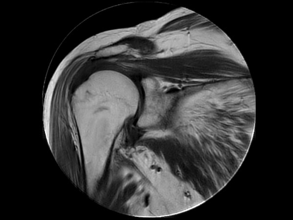 Coronal MultiVane XD - T1w TSE